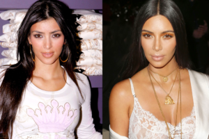 Kim Kardashian chirurgie